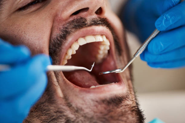 Oral Cancer Screening in South Fulton, TN